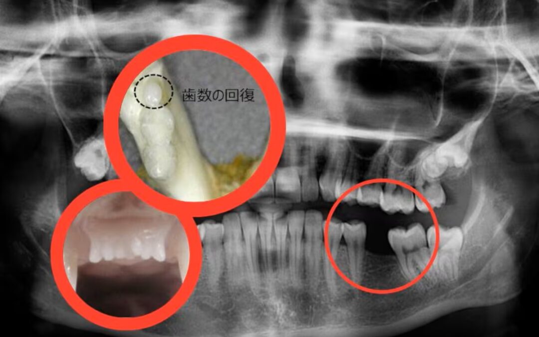 ¿Un futuro sin dentaduras? Japón prueba medicamento para regenerar dientes
