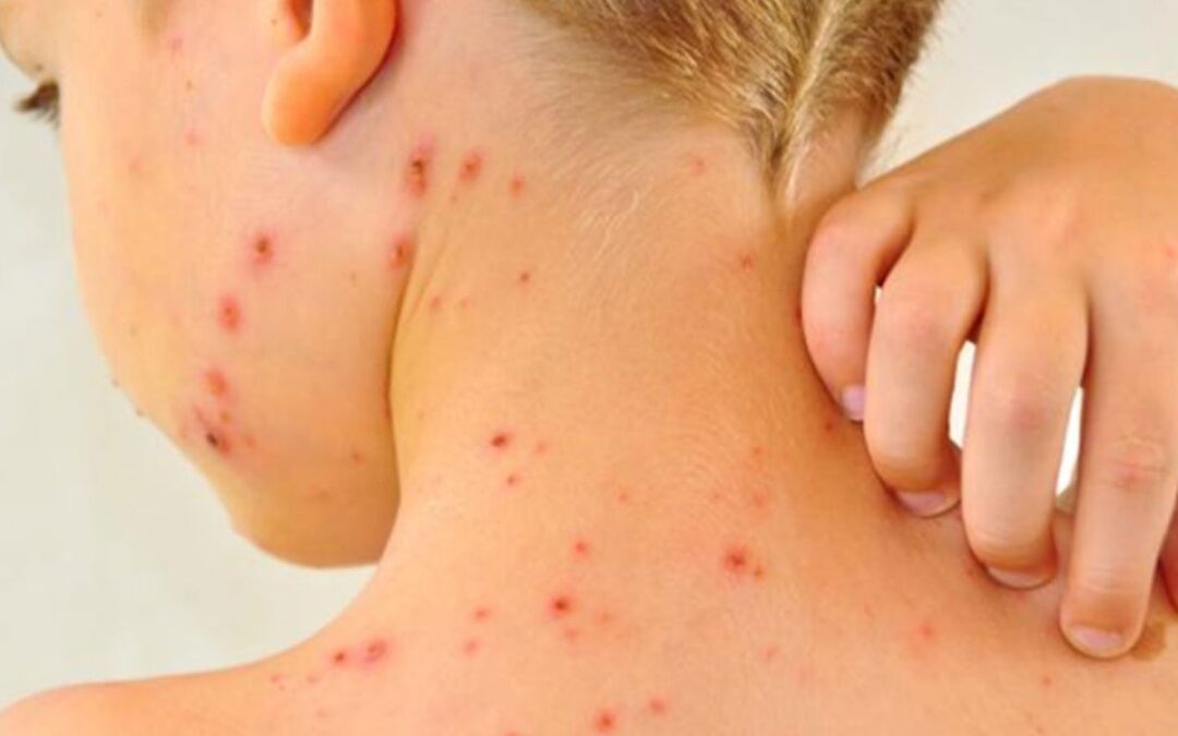 Preocupación en Utah y Arizona por brote de sarampión que supera los 120 casos